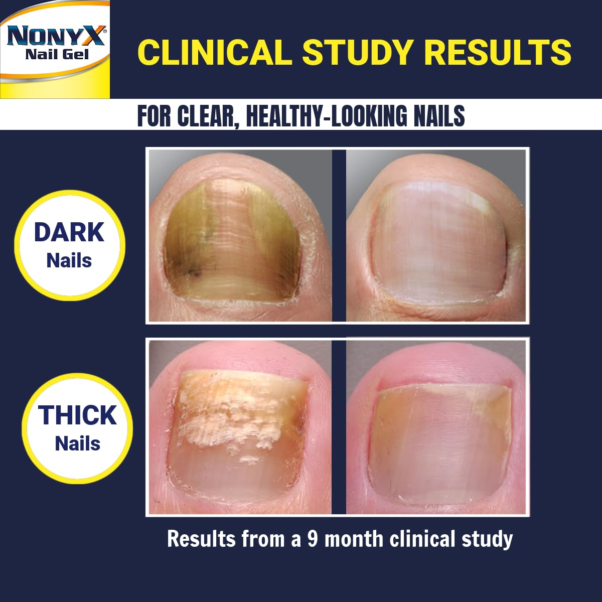 NONYX Fungal Nail Clarifying Gel | Clinically Proven for Discolored, Thick, Brittle, Yellow, Lifted, and other signs of Fungus-Damaged Toenails | 90% of Nails Improve | Over 8 million sold